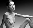 Anorexia. Storia di un'immagine